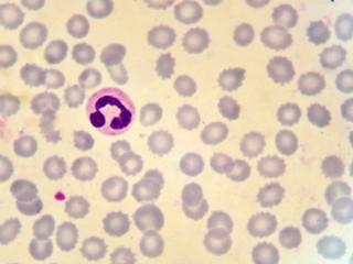 Neutrophil cell (white blood cell) in blood smear, analyze by microscope