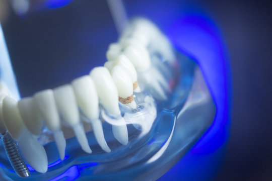 Dental teeth decay model