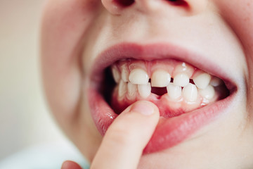 Child with first tooth missing