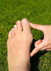 Hallux valgus, bunion in foot on grass background