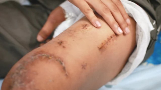 Hand of woman using cotton to cleaning  surgery wound broken bone knee of the man 