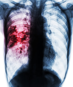 Pulmonary tuberculosis . Film x-ray of chest show patchy infiltrate at right lung due to TB infection