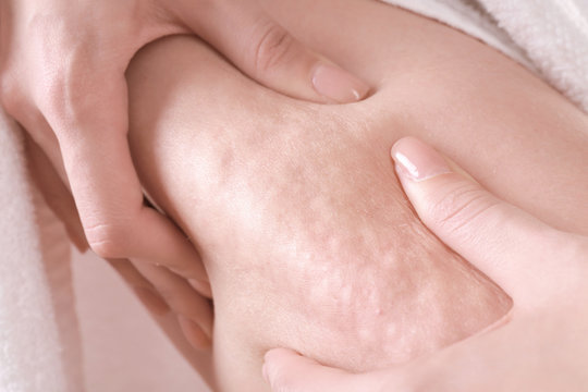 Woman with cellulite problem, closeup
