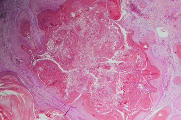 human cells, well differentiated squamous cell carcinomas