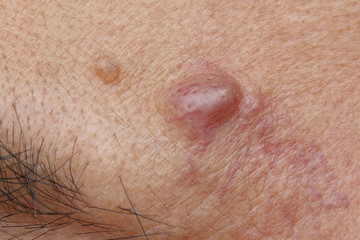 Close-up cyst on a human face