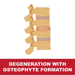 human disc degeneration. degeneration with osteophyte formation vector illustration