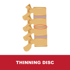 human disc degeneration. thinning disc vector illustration