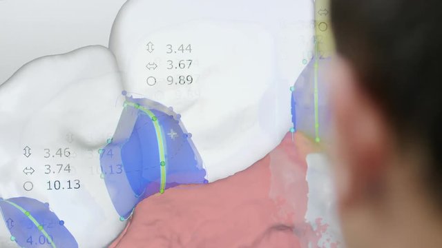 A man creates on the computer a model of the future prosthesis of teeth made on automatic process dental milling machine.