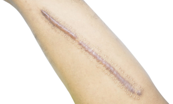 Closeup keloid scar on Asian man skin after femur fracture, broken thigh on white background with copy space.