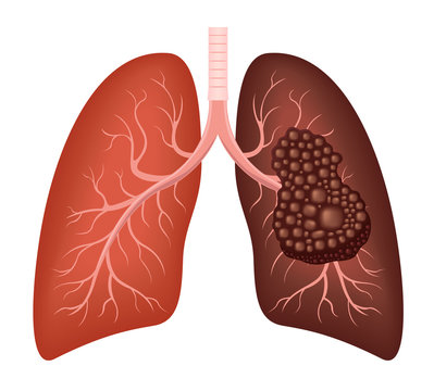 healthy lung and cancer lung vector