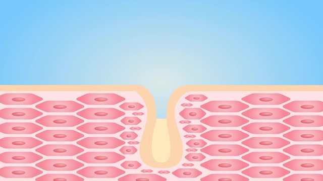 Acne and Pimples, stages of development, graphic illustration