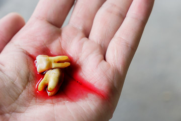 Close up teeth from extraction with blood on hand