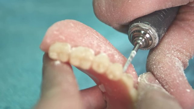 Dentist makes a dental implant prosthesis made of plaster cast