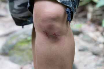 Wounds and blood on the knee Caused by running.