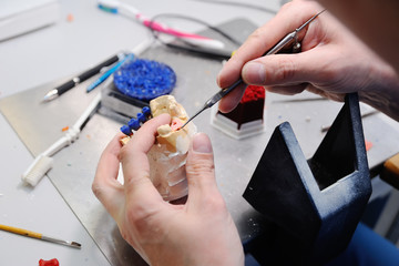 a dentist or orthodontist makes a ceramic imprint of the jaw. dentures