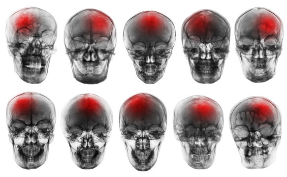Stroke . Cerebrovascular accident . Set of film x-ray skull