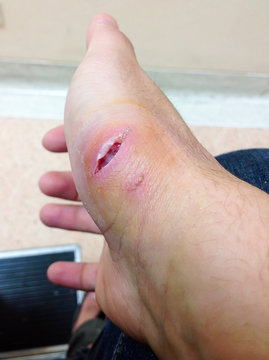 Treatment for dog bite on hand cheap