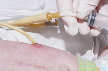 Nurse is feeding through g-tube after gastrostomy of newborn baby in neonatal intensive care unit at children's hospital