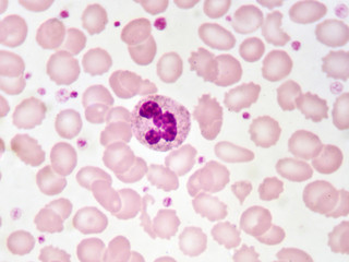 Neutrophil cell (white blood cell) in blood smear, analyze by microscope
