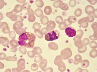 White blood cells in blood smear, analyze by microscope