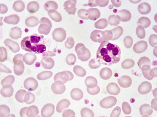 Neutrophil cell (white blood cell) in blood smear, analyze by microscope
