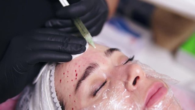 Young woman is lying on the couch while professional comsetologist in gloves is making multiple injections in woman's forehead during mesotherapy. Biorevitalization and face lifting