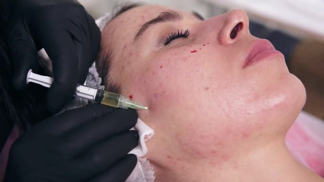 Professional cosmetologist makes multiple injections in woman's face skin during mesotherapy. Biorevitalization and face lifting, non-surgical cosmetic medicine treatment