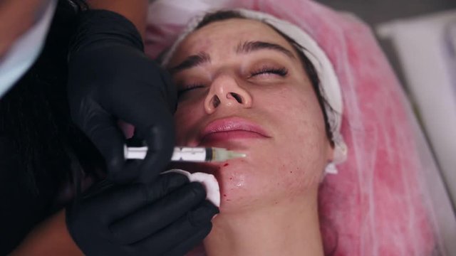 Young woman is lying on the couch while professional comsetologist in gloves is making multiple injections in woman's chin during mesotherapy. Anti-aging procedure