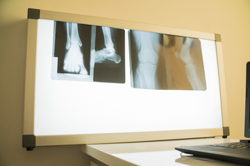x-ray images of bones of the leg joints in the doctor's office