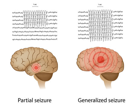 EEG in partial and generalized epilepsy
