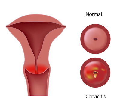 Cervicitis - inflammation of the cervix 