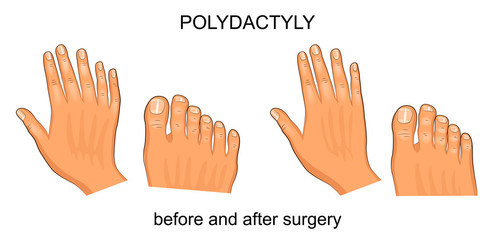 polydactyly before and after surgery