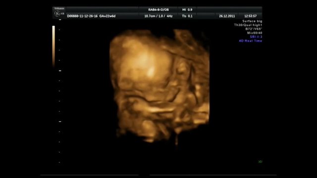 Ultrasound at 12 weeks gestation