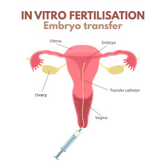 In vitro fertilization