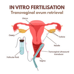 In vitro fertilisation