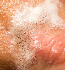 Fototapeta premium blood on the skin from a cut in hydrogen peroxide
