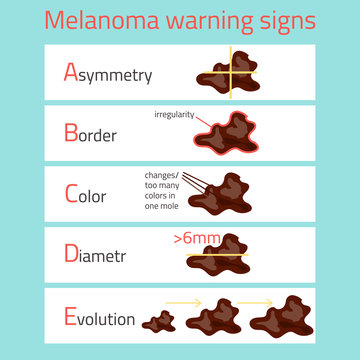 Melanoma Warning Signs ABCDE. Infographic Disease. Vector Illustration.