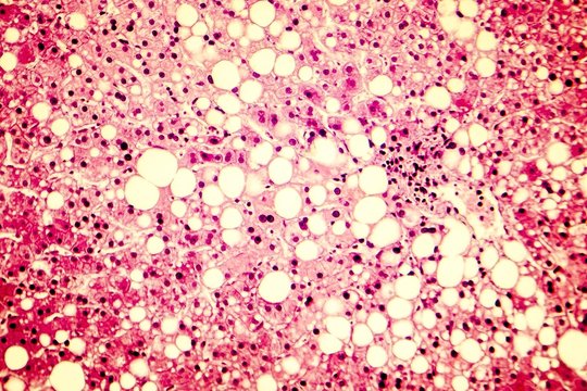 Fatty liver, liver steatosis. Photomicrograph showing large vacuoles of triglyceride fat accumulated inside liver cells, it occurs in alcohol overuse, under action of toxins, in diabetes