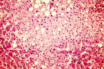 Fatty liver, liver steatosis. Photomicrograph showing large vacuoles of triglyceride fat...