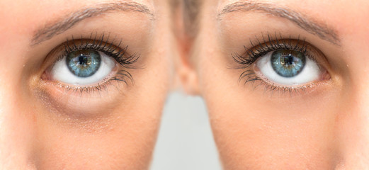 Beautiful female eye before and after blepharoplasy with and without eye bags
