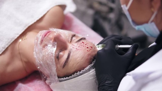 Closeup view of a professional comsetologist in black gloves making multiple injections in woman's face skin during mesotherapy. Biorevitalization and face lifting, non-surgical medicine treatment