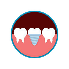 Dental implant in mouth with replacement crown for dentistry concept design. Vector modern flat style cartoon illustration icon. Isolated on white background