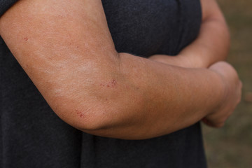 psoriasis on an elbow showing redness and dry patches.Eczema and other dry skin conditions