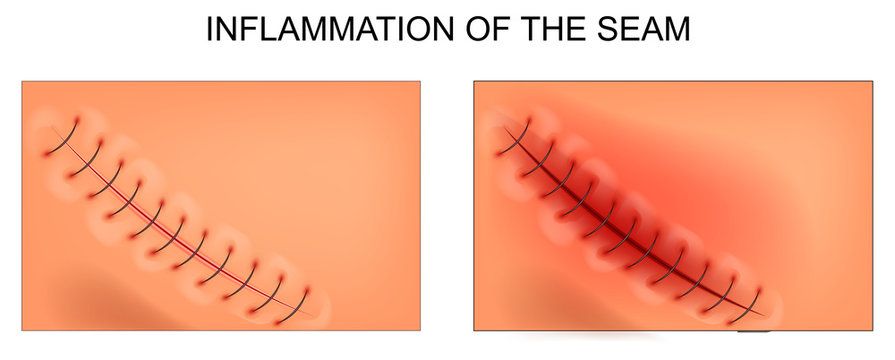 What is a wound