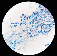 Smear of Acid-Fast bacilli (AFB) stained from human body fluid specimen with positive Mycobacterium tuberculosis (MTB) and many white blood cells (WBC), under 100X light microscope (Selective focus).
