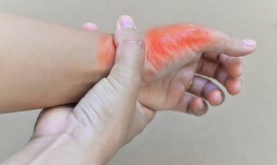 Painful and inflamed gout..