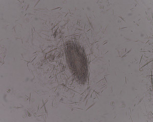 Moderate Uric acid crystal needle shape..