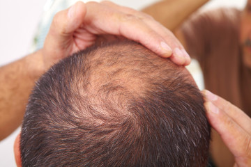 Senior man and hair loss issue