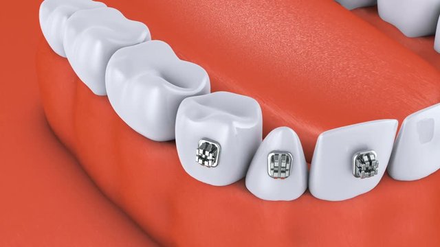 Animation dental brackets and tooth implant. 3D render.