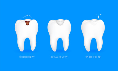 Step of tooth filling. Tooth decay, decay remove and white filling. Illustration isolated on blue background. Dental care concept.